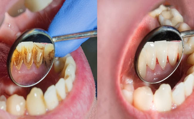 Teeth Cleaning Remedies: किचन में मौजूद इन चीजों का ऐसे करें इस्तेमाल, मोतियों से चमकने लगेंगे पीले दांत…