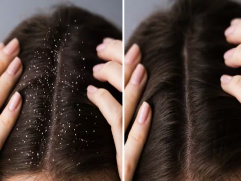 Dandruff: डैंड्रफ से छुटकारा दिलानें में रामबाण हैं ये घरेलू नुस्खा, जानिए बनाने और लगाने का तरीका