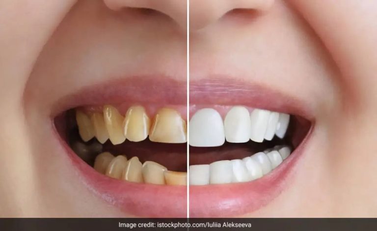 पीले होकर गंदे दिखने लगे हैं दांत और मुस्कुराने में भी होती है झिझक, तो ये 5 चीजें तुरंत दूर करेंगी दांतों का पीलापन
