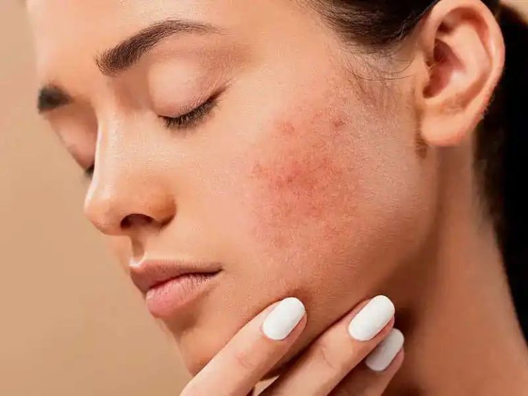 Skin Care Tips- एक्ने प्रोन स्कीन से परेशान हैं, इसकी देखभाल के लिए अपनाएं ये टिप्स