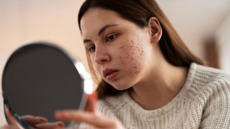Skin Pimples: धूल-मिट्टी ही नहीं, खाने की इन चीजों से भी हो सकते हैं पिंपल्स