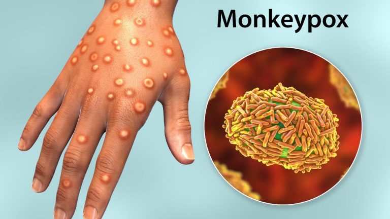 मंकीपॉक्स वायरस कितना खतरनाक है, WHO को क्यों घोषित करना पड़ा ग्लोबल हेल्थ इमरजेंसी